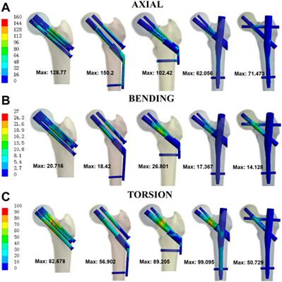 Biomechanical evaluation of two modified intramedullary fixation system for treating unstable femoral neck fractures: A finite element analysis